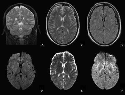 Adult Mild Encephalitis With Reversible Splenial Lesion Associated With Delirious Mania: A Case Report